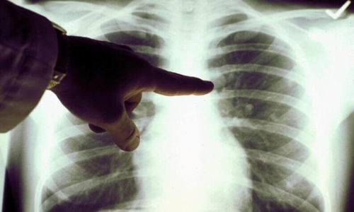 In 2008, tuberculosis was one of the key medical challenges in Ukraine.
