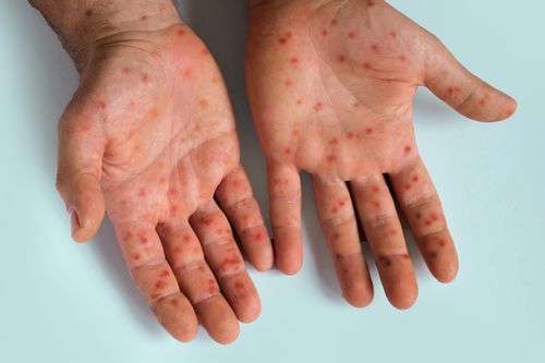 Measles epidemic: outbreaks caused by low vaccination rates.